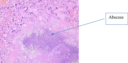 Figure 2 Intervillous abscess. HE x200. The abscess is surrounded by a rim of giant cells and palisaded histiocytes.