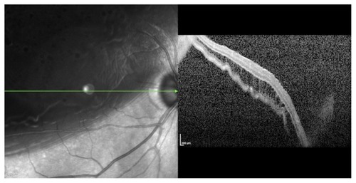 Figure 3 Preoperative optical coherence tomography (OCT) of the right eye of a 67-year-old female with a rhegmatogenous retinal detachment. The macula and the fovea are detached. Preoperative visual acuity (VA) was 20/400. The external limiting membrane and the inner segment/outer segment (IS/OS) junction of the photoreceptors were disrupted. There is evidence of outer retinal corrugation and cystoid macular edema (CME). The detachment was surgically repaired with a pars plana vitrectomy. The postoperative ELM and IS/OS junction remained disrupted on OCT. The VA 1-month postoperatively was 20/60.