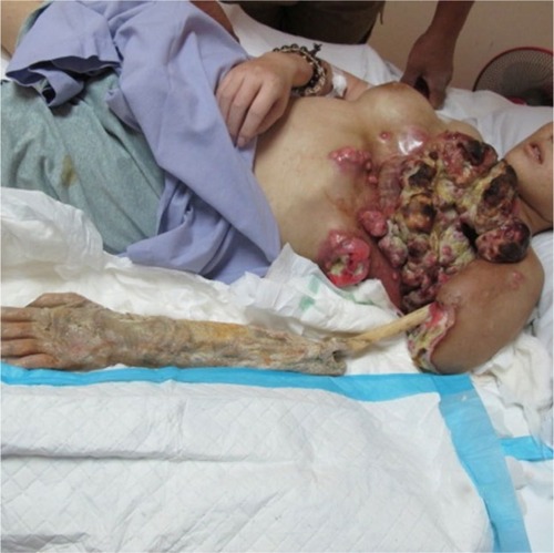 Figure 1 Cancer on the trunk with left humerus exposed and gangrenous arm.