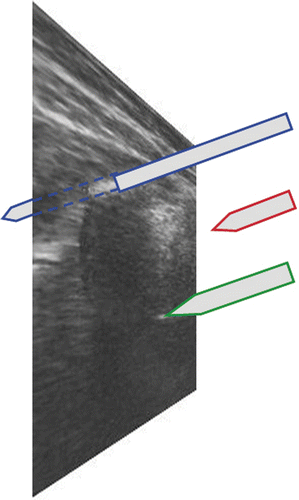 Figure 5. Three-dimensional space and a 2D ultrasound image. Blue: Behind the plane–the instrument is visible, but the instrument tip is not visible. Red: Above the plane–neither the instrument nor its tip are visible. Green: Exactly in the plane–the instrument tip is visible.
