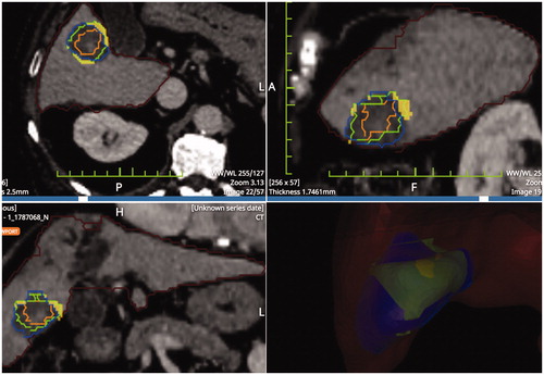 Figure 3. Result of pre- post-ablation registration: HCCs is the inner part, 5 mm margins (middle part) coagulation zone (outer part). The solid portion outside the necrosis is the unablated safety margin. Calculations rendered are: residual unablated nodule 0%, residual unablated 5 mm margin 7.8%.