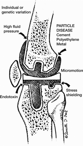 Figure 2. Drawing of a knee prosthesis with examples of different pathways leading to aseptic loosening.