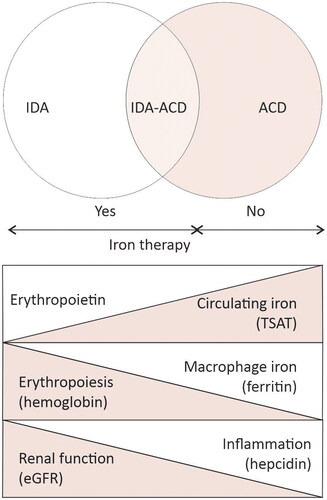 Figure 4. The spectrum of iron metabolism along chronic kidney disease stages. In early stages of CKD, the disbalance between iron intake and losses, reduces both the circulating iron (low transferrin saturation – TSAT) and the iron stores (low serum ferritin). the decline in erythropoiesis (low hemoglobin) is driven mostly by iron deficiency, e.g., “pure” iron deficiency anemia (IDA). in advanced CKD, as kidney function declines, erythropoietin production decreases and inflammation progress along with the increase in hepcidin production. Hepcidin inhibits hemoglobin production by immobilizing iron in macrophages (high serum ferritin). anemia is driven by iron restricted erythropoiesis, and by low erythropoietin levels, while circulating iron (TSAT) could be higher lower than normal, e.g., anemia of chronic disorders (ACD). during CKD, the individual contribution of each pathogenic factor of renal anemia varies, resulting in various combination of IDA and ACD. The identification of IDA, IDA-ACD overlap or ACD using serum ferritin and TSAT is important because is recommended in IDA and IDA-ACD while is contraindicated in ACD.