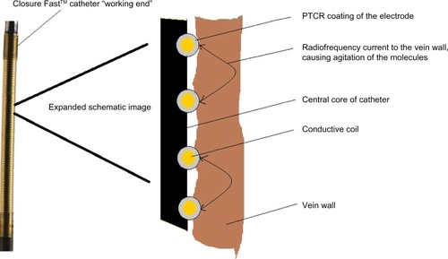Figure 1 Image of the distal end of the Closure Fast™ catheter (ClosureFAST, Covidien, Dublin, Ireland) with expanded schematic diagram to illustrate the process of radiofrequency ablation of the vein wall.