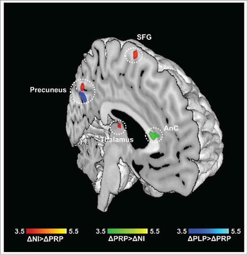 Figure 3. Emotional decision-making (ED) task. Regions showing differences in neural activity in the PRP group as compared to control groups, for N>B contrast (ΔPRP>ΔPLP, ΔNI >ΔPRP), and U>B contrast (ΔPLP>ΔPRP). Results are reported at p < 0.05 corrected for multiple comparisons using Alphasim corrections. (AnC: anterior cingulum; SFG: superior frontal gyrus).