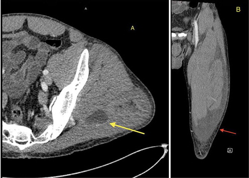 Figure 1. Computed tomography CT left hip with intravenous contrast. Image (a): Yellow arrow; illustrates measuring 3.2 cm. This measures 2 × 2.7 cm in diameter. There is overlying subcutaneous edema. Image (b): Red arrow; inflammatory changes extend into the lateral and anterolateral thigh to the level of the knee. There is fluid seen ventral to the quadriceps muscle, possibly deep to the fascia