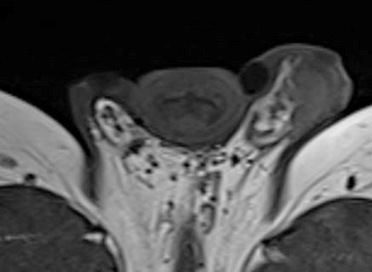 Figure 2 MRI scan, transaxial position, T1WI bilateral intra-scrotal nodular shadow with low signal.