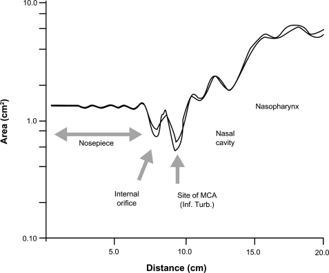 Figure 3 Acoustic rhinometry trace. Results of three superimposed rhinometry traces of the left nostril demonstrate the high reproducibility of this technique.