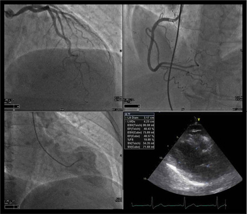 Figure 2. a–d: (a, b) Cine shot of coronary vasculature showing no evidence of obstructive coronary disease. (c) Left ventriculogram push demonstrating focal wall hypokinesis. (d) Transthoracic echocardiogram demonstrating EF: 40%.