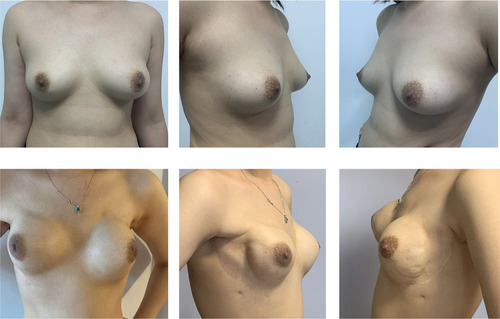 Figure 2 Bilateral nipple-sparing mastectomy and one-stage implant-based breast reconstruction without matrix. A 27-year-old woman with bilateral invasive carcinoma and axillary lymph node metastasis before surgery (above). Photos at 1year postoperatively (below).