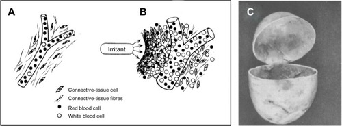 Figure 10 Formation of the inflammatory barricade.Notes: Copyright © 1984, Selye H. Reproduced from Selye H. The Stress of Life. Revised ed. New York: McGraw-Hill Companies, Inc.; 1984.Citation25 (A) Normal connective tissue territory. (B) Same tissue after injury or exposure to irritant. Vessel dilates, blood cells migrate toward irritant, connective tissue cells and fibers form a thick impenetrable barricade that prevents the spread of the irritant into the blood, but that also inhibits entry of regenerative cells that could repair the tissue and slow the entry of antioxidants into the repair field. The result can be a long-lasting pocket of incompletely resolved inflammation that can eventually leak toxins into the system and disturb functioning of an organ or tissue. This is referred to as “silent” or “smoldering” inflammation. (C) The inflammatory, Selye, or granuloma pouch as originally described by Selye,Citation30 is widely used in studies of inflammation.