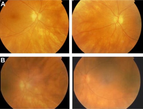 Figure 3 Fundus photograph in a 56-year-old woman with birdshot chorioretinopathy (A) before and (B) after treatment.