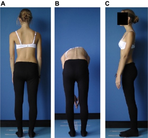 Figure 1 Clinical signs of idiopathic scoliosis. (A) Trunk asymmetry and lateral deviation of the spine in the frontal plane, (B) trunk rotation in the horizontal plane, and (C) disturbances in physiological curvature in the sagittal plane (kyphosis flattening).