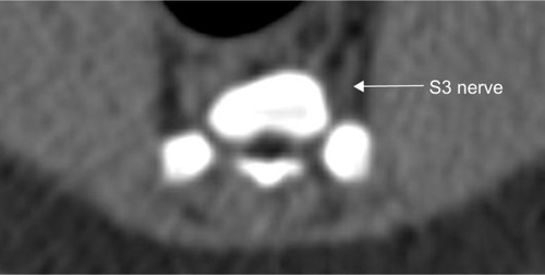 Figure 3 Course of the sacral nerve root S3 (arrow) of one selected minipig.