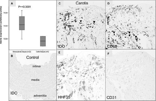 Figure 1. Indoleamine 2,3-dioxygenase (IDO) expression in atherosclerotic and control artery samples. A: Gene expression value is the normalized average gene intensity for each group measured in the Illumina Expression BeadChips. Median IDO expression levels in atherosclerotic and non-atherosclerotic control tissues were 152.5 (119.1–185.1) and 114.8 (102.6–125.7), respectively. Mann-Whitney U test relative to control tissues. B–F: IDO immunoreactivity in human atherosclerotic plaques. Internal thoracic artery sample served as a control (B). In IDO staining, arrows point to IDO-positive macrophages. Also smaller cells (arrow-heads) are labeled (C). Staining with monocyte marker CD68 shows labeled macrophage (arrow) and monocytes (arrow-heads) (D), whereas labeled monocytes and macrophages could not be identified from smooth muscle cell marker HHF35 staining (E). No staining was seen with endothelial cell marker CD31 (F) in human carotid artery plaques. The stage of atherosclerosis was classified according to American Heart Association classification. 100× magnification.