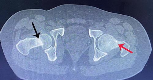 Figure 3 An axial CT scan reveals an intracapsular displaced fracture of the right femur neck (black arrow). There is a nondisplaced femoral neck fracture on the left side (red arrow).