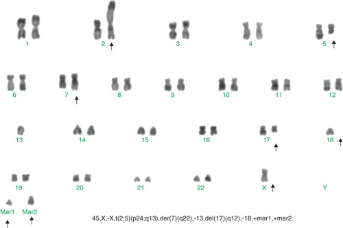Figure 1. Karyotype: 46, X,-X, t(2;5)(p24;q13), der(7)(q22), -13,del(17)(q12), -18, +mar1, +mar2.