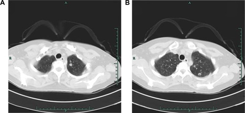 Figure 4 Chest CTs showing multiple pulmonary nodular lesion (A) and pulmonary cavitation (B).