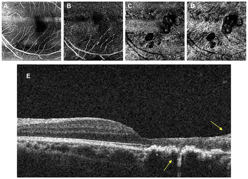 Figure 3 The left eye OCTA image of the first case. The analysis of the superficial retinal layer (A) and deep retinal layer (B) showed hypointense areas marked as dark areas, which revealed decreased perfusion. These findings are also noted in choriocapillaris (C), but the choroidal layer (D) only showed multiple dark spots due to the previous retinochoroidal scar. The horizontal section of retinal layer (E) showed full thickness retinal thinning with disruption of the RPE and epiretinal membrane formation (yellow arrow).