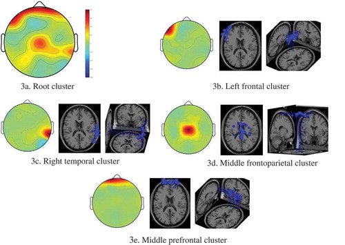 Figure 3. Scalp maps and 3D dipole plots for the rock and roll stimulation results(a) Root cluster, (b) Left frontal cluster, (c) Right temporal cluster, (d) Middle frontoparietal cluster, (e) Middle prefrontal cluster.