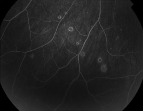 Figure 1 Late frame fluorescein angiographic photograph of the right eye demonstrating well demarcated hyperfluorescent lesions.