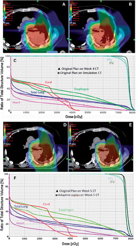 Figure 2. Proton Beam dosimetry is sensitive to tumor response to treatment. A) Axial CT imaging of a proton beam dose distribution from the original plan in a patient with T3N2 adenocarcinoma. B-C) During week 4 of routine repeat CT simulation, there was clear evidence of response to therapy with necrotic hollowing of the tumor center. This alters the proton beam dose distribution, with increased dose to adjacent normal structures but without a compromise to tumor coverage. D-E) Adaptive plan was done on the week 5 CT simulation scan in order to improve the dose distribution, with DVH in F) showing reduced normal tissue doses compared to what would have been delivered if no adaptive planning was performed.