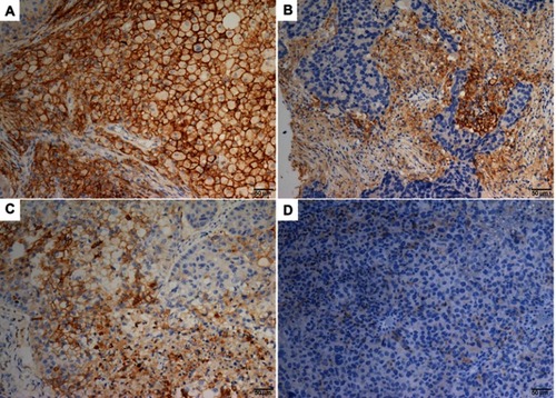 Figure 2 Representative IHC staining of for PDL1 expression shown in LCLC tissue.Notes: Membranous positive staining of PDL1 in tumor cells (A) and TILs (B). Membranous positive and negative staining of PDL1 in tumor cells (C) and TILs (D). Original magnification ×20.Abbreviations: IHC, immunohistochemistry; LCLC, large-cell lung carcinoma; TILs, tumor-infiltrating lymphocytes.