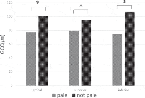 Figure 5. GCC thickness divided into two quadrants with and without a pale ONH.GCC, ganglion cell complex; ONH, optic nerve head.