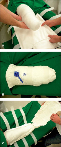 Figure 1. The residual limb placed on the posterior shell of the ORD. B) The ORD after removal of all air and its application completed. C) The ORD opened for wound inspection.