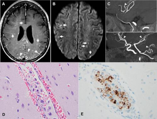 Figure 3 (A) Axial contrast-enhanced T1-weighted MRI showing multifocal subcortical perivascular intraparenchymal enhancement (short white arrows) and leptomeningeal enhancement (arrowheads). (B) Small cortical and subcortical infarcts corresponding to the distribution of perivascular enhancement (short white arrows). (C) MR angiography showing focal narrowing of several intracranial arteries (arrowheads). The H&E section of brain biopsy shows focal intravascular infiltrate of neoplastic large lymphocytes ((D), ×40); and they are positive for CD19 ((E), ×40).