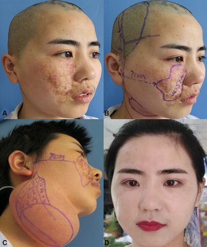 Figure 4 Case 4. A 22-year-old female had PWS with obvious scars and pigment anomalies in the right face after photodynamic therapy. Expanded prefabricated flap was used. The right temporoparietal fascial flap was harvested in the first-stage operation and placed under the pre-separated flap in the neck. Rated capacity of the expander was 200 mL. Regular expansion lasted for 114 days with final capacity of 392mL. The expanded prefabricated flap was transferred to the wound through subcutaneous tunnel after the removal of lesion in the second-stage operation. The flap survived well. (A) Preoperative lateral view. (B) Preoperative marking of the frontal and parietal branches of the superficial temporal vessels and operation design. (C) Lateral view before the second-stage operation. (D) Postoperative view with make-up two years later. Evaluation result was “very pleased (score of 4)”.