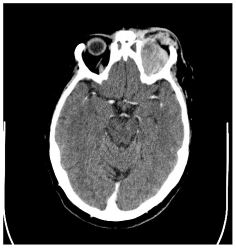 Figure 1 A fairly well defined lesion measuring 31 mm × 31 mm × 16 mm can be seen in the superior aspect of the extraconal space of the left orbit, pushing the superior rectus and levator palpabrae superioris inferolaterally and causing significant proptosis. Both frontal sinuses were completely opacified, including the paranasal sinuses.