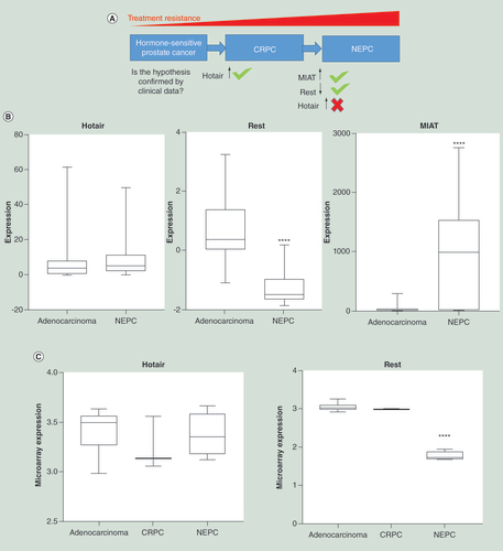 Figure 1.  The role of HOTAIR, REST, and MIAT in prostate cancer progression. (A) A unified model describing the role of HOTAIR, REST, and MIAT in the three main stages of prostate cancer progression. (B) Clinical samples from patients with prostate adenocarcinoma, and neuroendocrine prostate cancer (NEPC). REST is signficantly downregulated in NEPC vs adenocarcinoma (p < 0.0001). MIAT is signficantly upregulated in NEPC vs adenocarcinoma (p < 0.0001). (C) PDX models of prostate adenocarcinoma, castration resistant prostate cancer (CRPC), and neuroendocrine prostate cancer (NEPC). REST is signifiantly downregulated in NEPC vs adenocarcinoma and CRPC (<0.0001). (C) Data analysed by two-tailed t-test. Data analyzed by one-way analysis of variance with Tukey’s post-hoc test. All data analyzed using graphpad Prism 7 software.