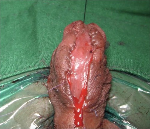Figure 3 Ventral urethrostomy inpatient with complex penile stricture after failed hypospadias.