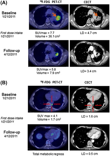 Figure 4. A and B Transaxial images at baseline and 3-month follow-up with FDG PET-CT and contrast-enhanced CT (CECT) in a patient with a primary NSCLC (solid arrows) in the left lung and pleural metastases (cross marked). A) shows a significant reduction in the primary tumor metabolism measured in maximum standardized uptake value (SUVmax, g/mL) and size on CECT evaluated with the RECIST 1.1 criteria (LD, transaxial longest diameter) at 3-month follow-up. B) shows a concordant significant reduction in the pleural metastases with total metabolic regress on FDG PET-CT after treatment.