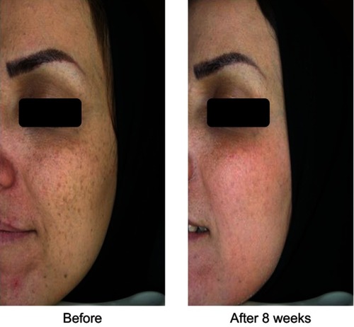 Figure 4 Patient treated with Januluma cream at: (A) baseline and (B) week 8.