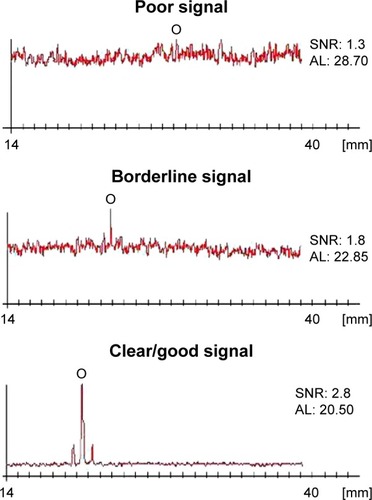 Figure 1 Different levels of signal quality resulting from optical biometry. Abbreviations: AL, axial length; SNR, signal-to-noise ratio.
