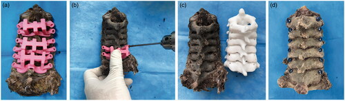 Figure 3. The surgical procedure of pedicle screw insertion with the assistance of rapid prototyping navigation template. (a) The navigation templates fit closely to the posterior surface of corresponding vertebral body. (b) A high-speed drill bit was used to drill channels through navigation template. (c) The cervical specimen and corresponding physical vertebra model. (d) Pedicle screw insertion into the cervical specimen through designed screw channels.