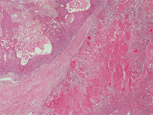 Figure 5. Basaloid cells with palisading in the peripheral areas of lobules are present. H&E; original magnification, ×100.
