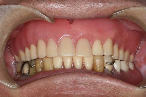 Figure 22 The frontal view 10 years after the delivery of the dentures.