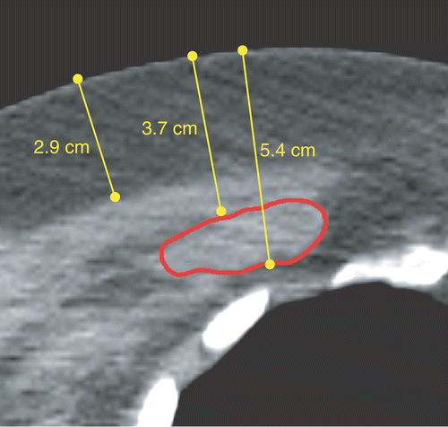 Figure 8. Transverse CT slice through the centre of the tumour. The tumour outline is indicated with a contour. The arrows show the tumour depth (3.7–5.4 cm), and the thickness of the fat layer (2.9 cm).