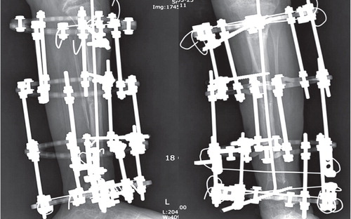 C. Anteroposterior and lateral radiographs of the child after excision of sclerotic bone ends, antegrade nailing, and application of the Ilizarov method. D. Anteroposterior and lateral radiographs of the child 2 years after surgery, showing well-united tibia with acceptable axial alignment.