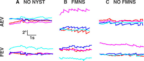 Figure 1 Gaze positions as a function of time in patients without nystagmus (A), with FMNS (B), and with nystagmus but not FMNS (C) as they fixated on a target monocularly with the amblyopic (top) and fellow (bottom) eyes. Note the large drift amplitudes in the subject without nystagmus. FMNS can be distinguished by the reversal in slow phase direction that occurs when the eye under cover is changed. Red - right horizontal, magenta – right vertical, blue – left horizontal, cyan – left vertical. Rightward and upward movements correspond to the positive vertical axis.
