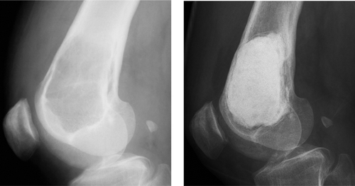 Figure 1. A. Giant cell tumor of the distal femur, treated with evacuation and cement filling. B. After 11 years, there were no signs of recurrence and no deleterious effects of the cement.