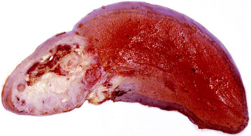 Figure 9.  Liver metastasis of thyroid cancer (compare scan in Figure 8).