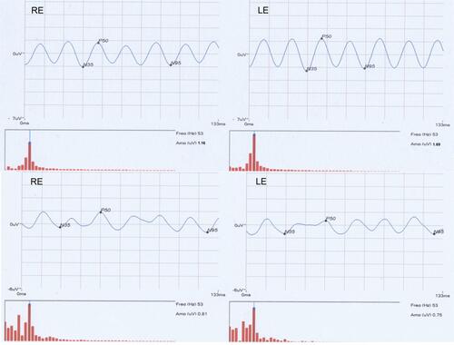 Figure 1 Steady-state pattern electroretinogram waveforms recorded in the right and left eye of control normal subject (top) and dyslexic subject (bottom). It can be observed a reduction of waveform amplitude in both eyes of the dyslexic subject (bottom) against the normal subject (top). Moreover, the dyslexics have a waveform amplitude decrease in the LE compared to the RE while in the normal subjects we have a slight increase in waveform amplitude in the LE than in the RE.Abbreviations: RE, right eye; LE, left eye.
