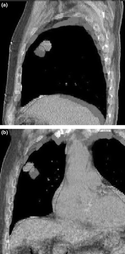 Figure 1.  4DCT planning images at maximum inspiration and expiration phases for a patient with an upper lobe lung lesion in (a) sagittal and (b) coronal orientations.