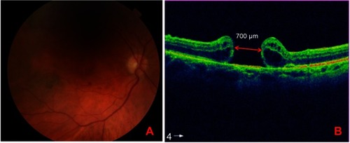 Figure 1 Retinography and optical coherence tomography (OCT) of recurrent myopic macular hole. (A) Retinography of the right eye showing the macular hole. (B) OCT of recurrent myopic macular hole in the right eye.