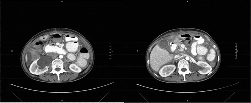 Figure 4. Severe right greater than left hydroureteronephrosis with a transition point in the mid to distal ureter, but no obvious obstructing mass or stone.