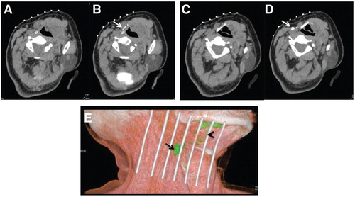 Figure 1. A case of CT lymphography for T2N0 tongue cancer. (A) Control CT image before iopamidol injection (section at lymph vessel level). (B) CT image 1 min after iopamidol injection. Arrow, lymph vessel. (C) Control CT image before iopamidol injection (section at sentinel lymph node (SLN) level). (D) CT image 3 mins after iopamidol injection. Arrow, SLN, which is the first enhanced lymph node. (E) Three-dimensional CT lymphography reconstructed from the images after injection. Arrow, SLN; arrowhead, lymph vessel.
